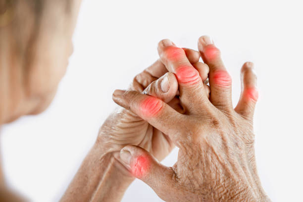 Older hand highlighting joints, related to managing high uric acid and gout symptoms